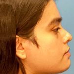 Facial Feminization Before & After Patient #882