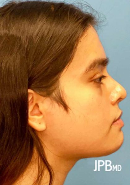 Facial Feminization Before & After Patient #882