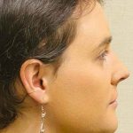 Facial Feminization Before & After Patient #876
