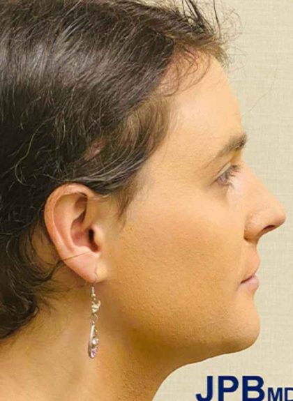 Facial Feminization Before & After Patient #876
