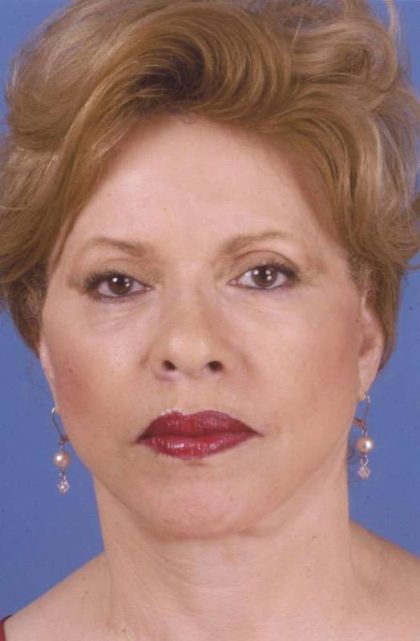 Facelift Before & After Patient #999