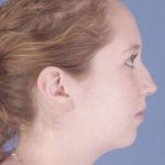 Rhinoplasty Before & After Patient #1092