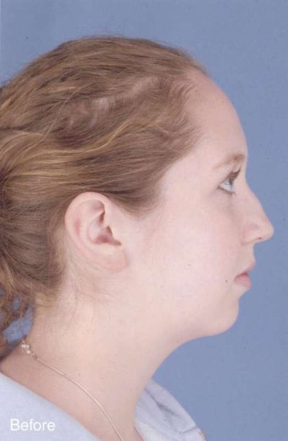 Rhinoplasty Before & After Patient #1092