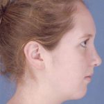 Rhinoplasty Before & After Patient #1092