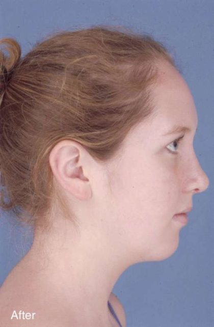 Rhinoplasty Before & After Patient #1092
