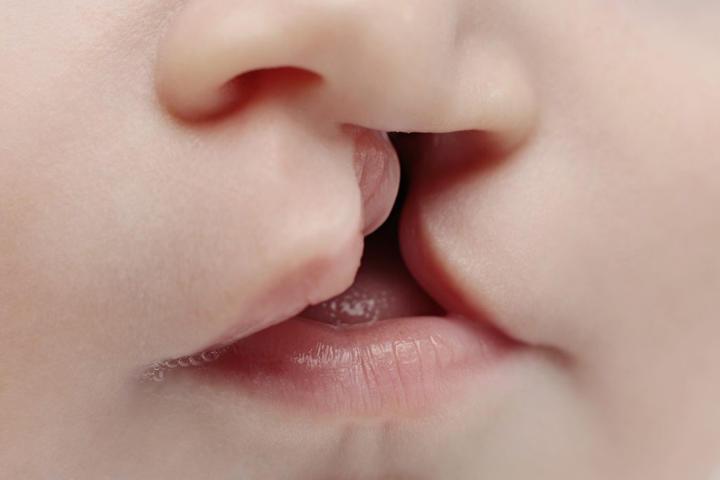 Cleft Rhinoplasty